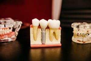 Lire la suite à propos de l’article <strong>Mieux comprendre son dentiste : quelle différence entre un implant et une couronne ?</strong>