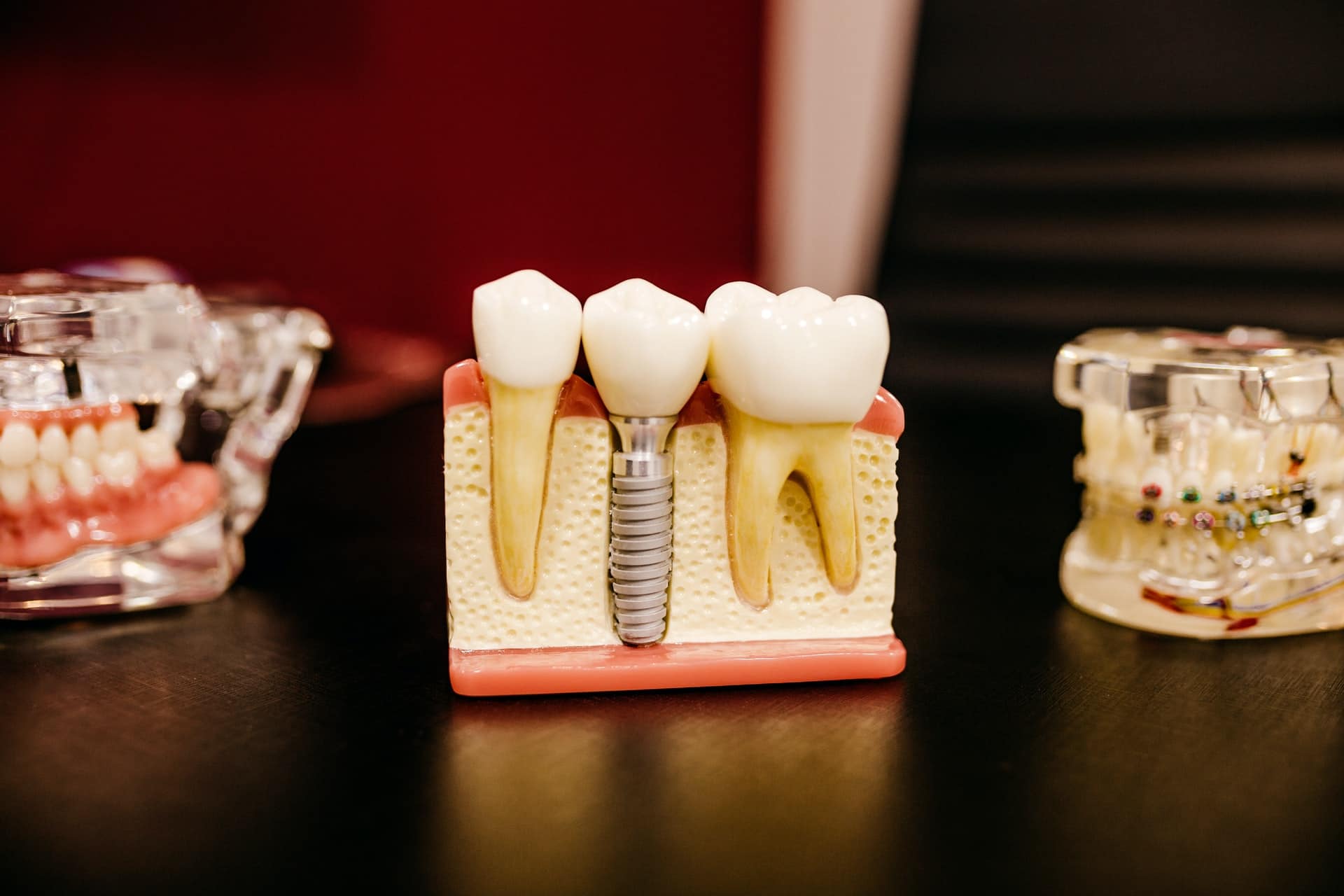 You are currently viewing <strong>Mieux comprendre son dentiste : quelle différence entre un implant et une couronne ?</strong>